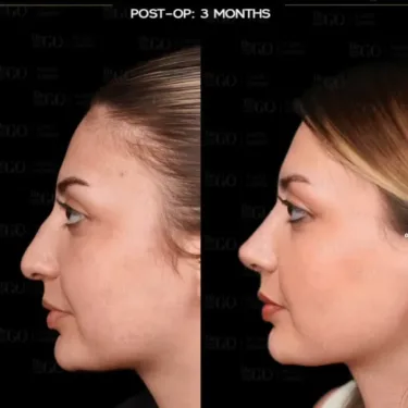 Rhinoplasty