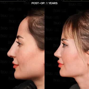 Rhinoplasty