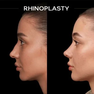 Rhinoplasty