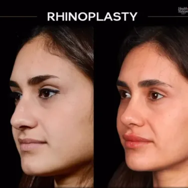 Rhinoplasty