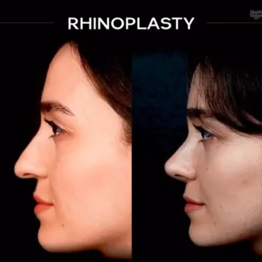 Rhinoplasty