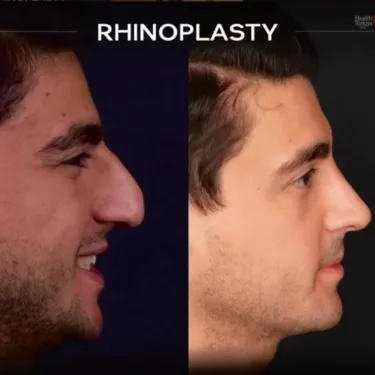 Rhinoplasty