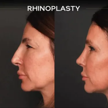 Rhinoplasty