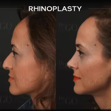 Rhinoplasty