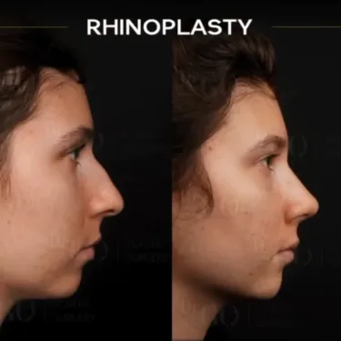Rhinoplasty