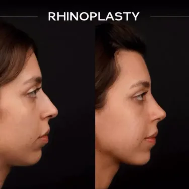 Rhinoplasty