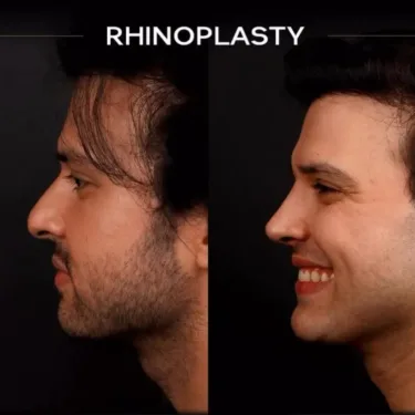 Rhinoplasty