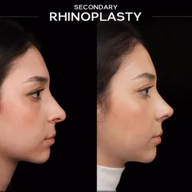 Rhinoplasty