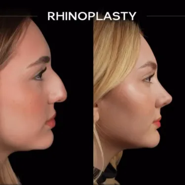 Rinoplastia