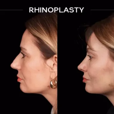 Rhinoplasty