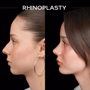 Rinoplastia