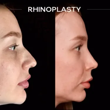 Rhinoplasty
