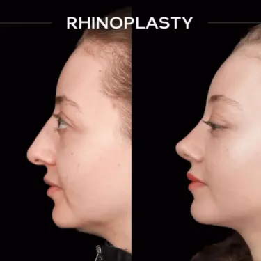 Rhinoplasty
