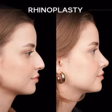 Rinoplastia