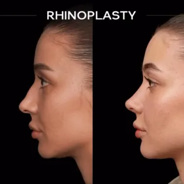 Rhinoplasty