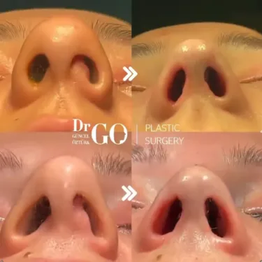 Nose surgery