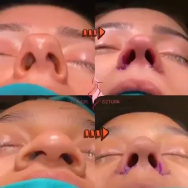 Nose surgery