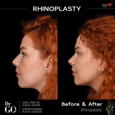 Nose surgery