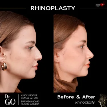 Nose surgery