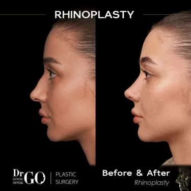 Nose surgery
