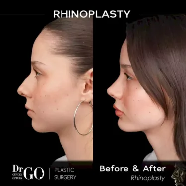 Nose surgery