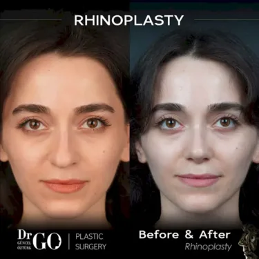 Nose surgery