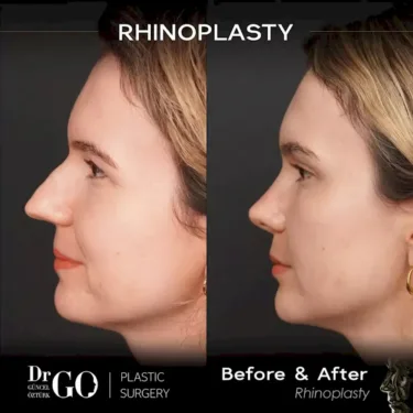 Nose surgery