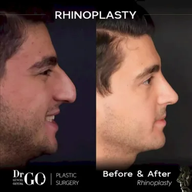 Nose surgery