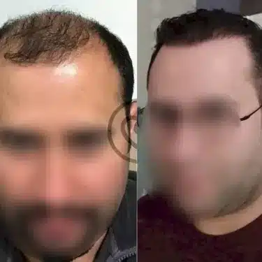 Трансплантация волос