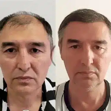 Трансплантация волос