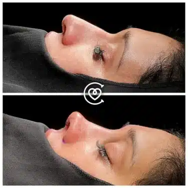 Ринопластика