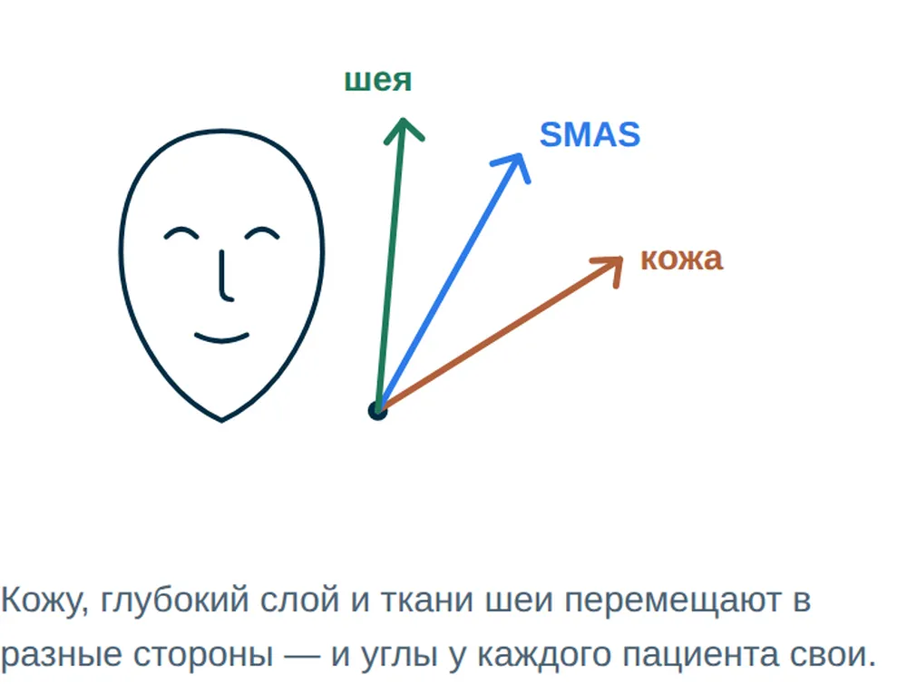 Индивидуальные направления перемещения кожи, SMAS и тканей шеи