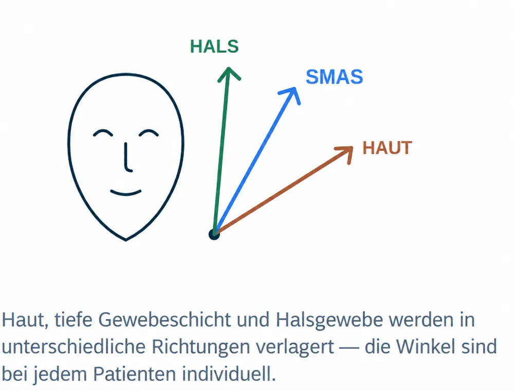 Individuelle Verlagerungsrichtungen von Haut, SMAS und Halsgewebe