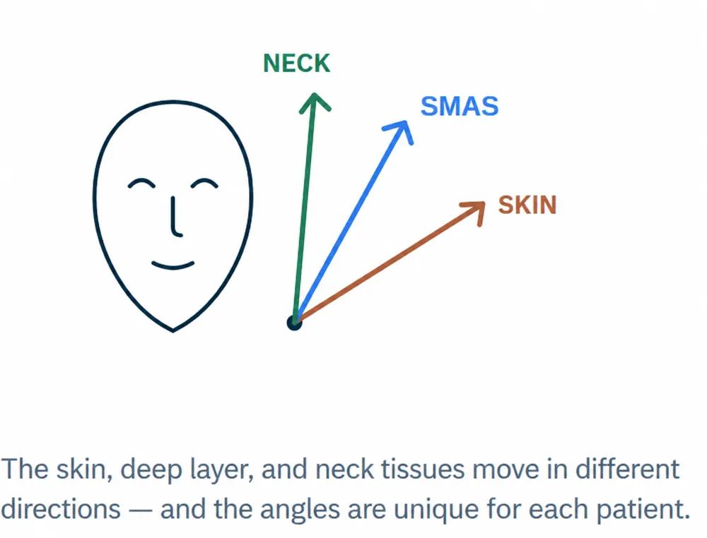 Individual directions of skin, SMAS and neck-tissue movement