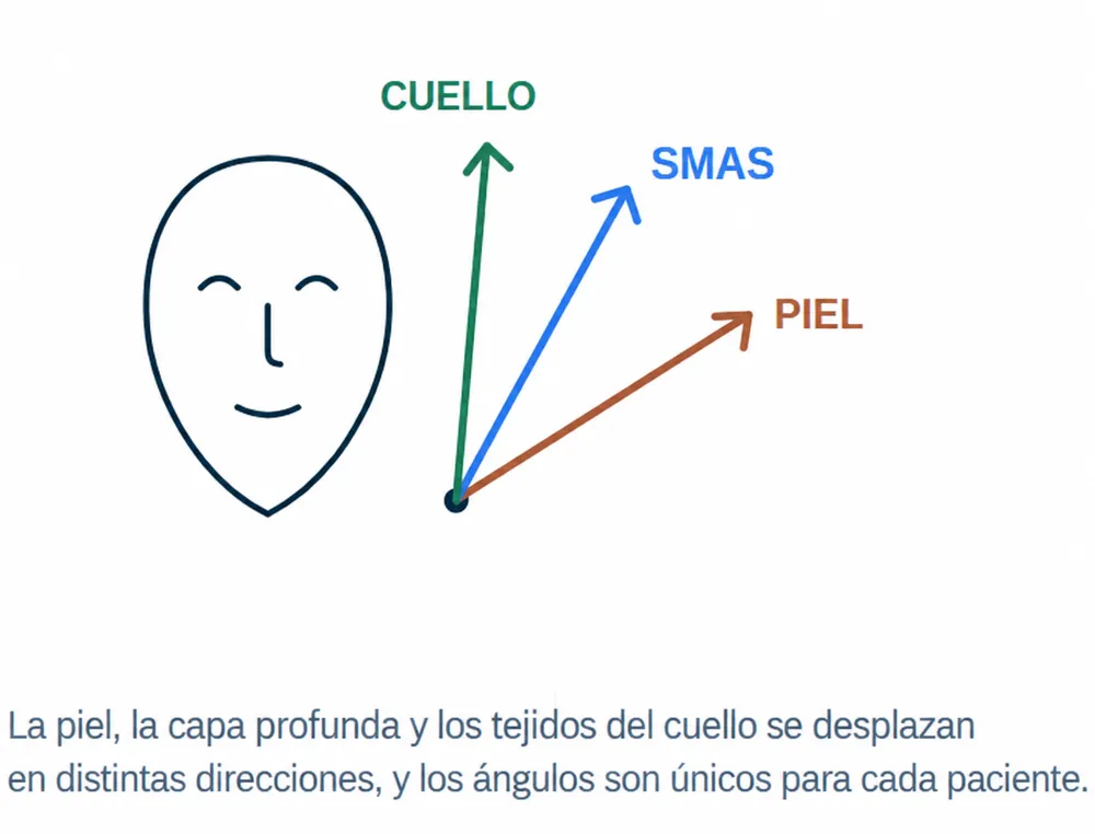 Direcciones individuales del desplazamiento de la piel, el SMAS y los tejidos del cuello