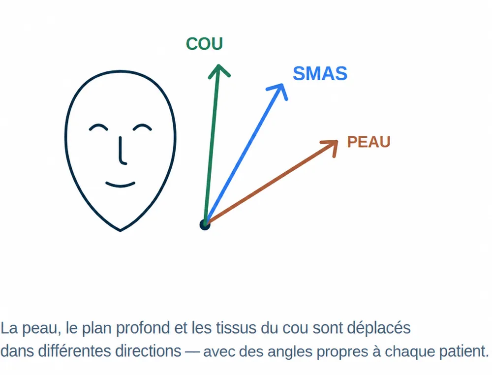 Directions individuelles du déplacement de la peau, du SMAS et des tissus du cou