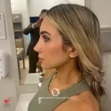 Rhinoplasty