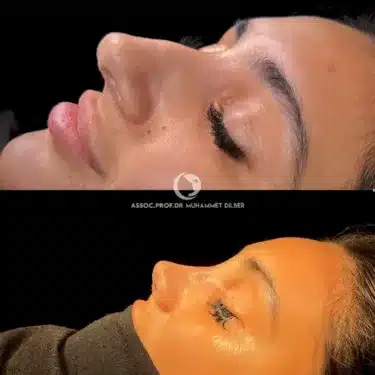 Rhinoplasty