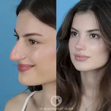 Rhinoplasty