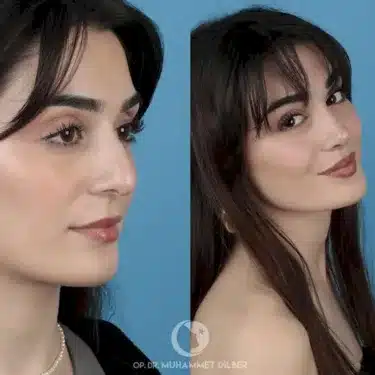Rhinoplasty