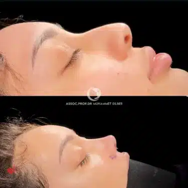 Rhinoplasty
