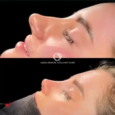 Rhinoplasty