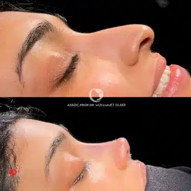 Rhinoplasty
