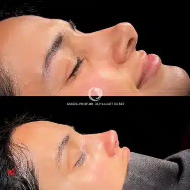 Rhinoplasty