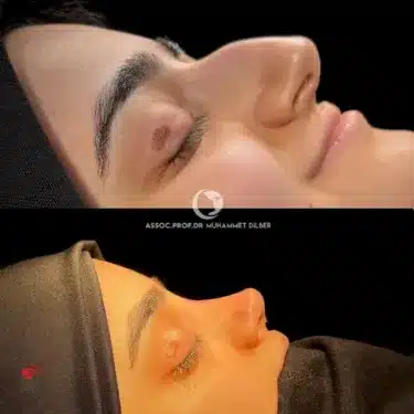 Rhinoplasty