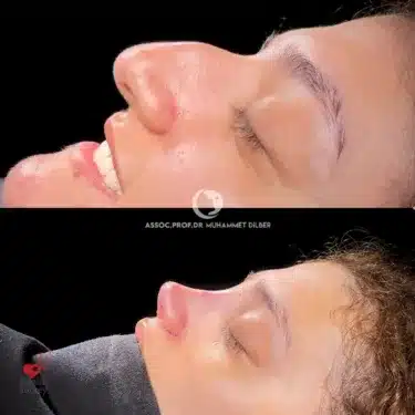 Rhinoplasty