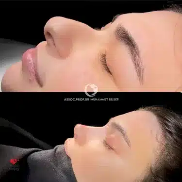 Rhinoplasty