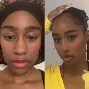 Rhinoplasty