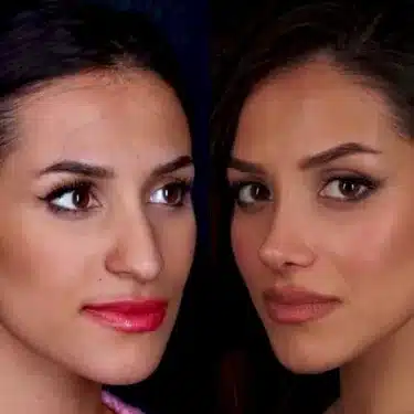 Rhinoplasty