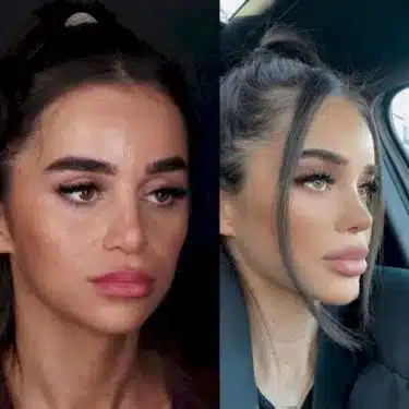 Rhinoplasty